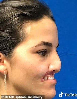 Model Who Had Her Lip Ripped Off By A Pit Bull Shares Her