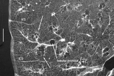 Centriacinar emphysema. Contact radiograph of an infl ated fi xed lung ...