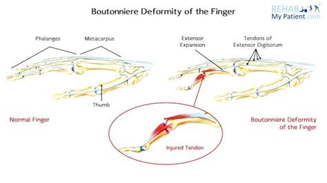 Boutonniere deformity