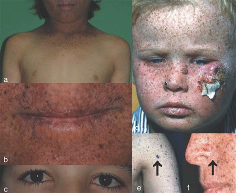 Xeroderma Pigmentosum Diagnostic Procedures Interdisciplinary Patient