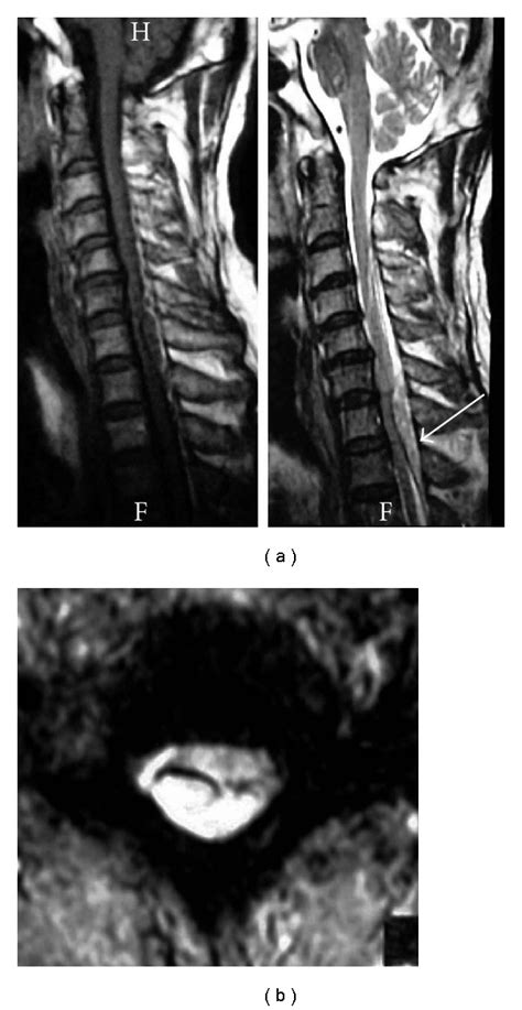 Preoperative Sagittal A And Axial B MR Images Showing A Right