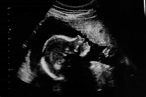 Whats The Importance Of Morphological Ultrasounds