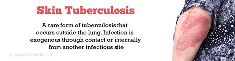 Skin Tuberculosis Causes Symptoms Diagnosis Treatment And Prevention