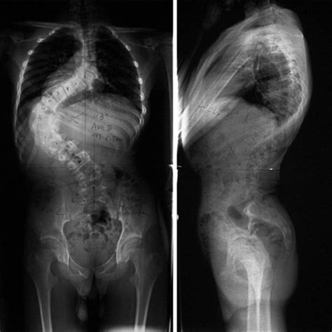 Standing Anteroposterior And Lateral Radiographs Of The Preoperation