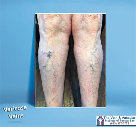 Varicose Veins Tampa Vascular Surgeon The Vein And Vascular Institute