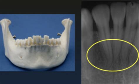 Radiographic Anatomy Of Intraoral Radiographs Flashcards Quizlet