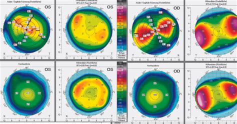 Crstg Europe Edition Extreme Hyperopic Astigmatism