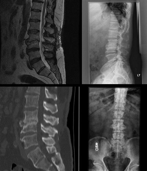 Extreme Lateral Interbody Fusion Xlif A Novel Surgical Technique For