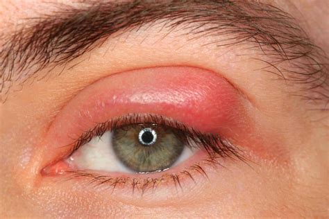 12 Chalazion Treatment Home Options and Tips - Home Remedies