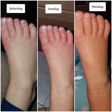 Hand, foot and mouth disease (viral infection) (2 testimonials) - A ...