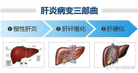 肝硬化的早期症状和治疗方式 知乎