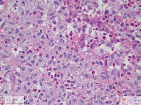 Langerhans Cell Histiocytosis