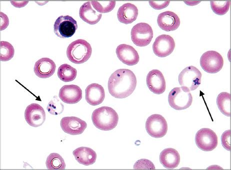 Pappenheimer Bodies Vs Basophilic Stippling