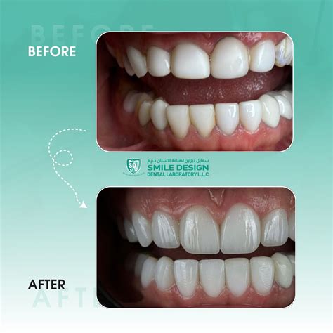 Smile Designs Dental Laboratary (@smile_design_dental_laboratory ...