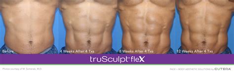 Trusculpt Before And After Pictures Muscle Sculpting And Fat Reduction