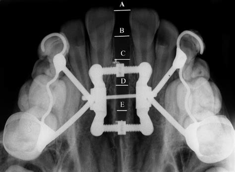 Scanned Occlusal Radiograph And Measurements Performed The Following Download Scientific