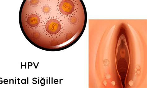 Hamilelikte Genital Siğiller Neden Olur Nasıl Tedavi Edilir Agucuk net