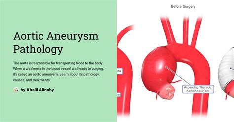 Aortic Aneurysm Pathology