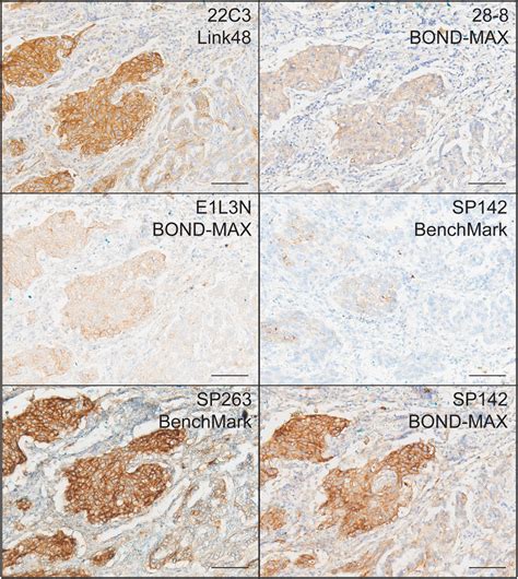 Representative Ihc Stains Of Pd L In Nsclc Using C Link