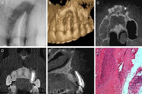 Diagnóstico diferencial entre el granuloma periapical y el quiste ...