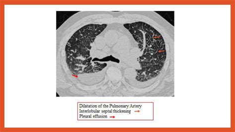 Signs of Pulmonary edema resulting from left heart failure | Download ...