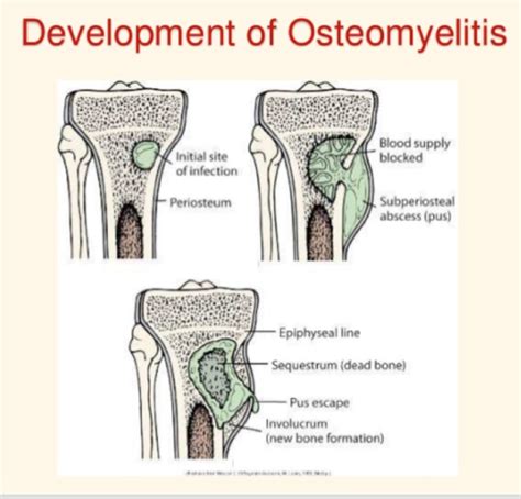 Bone And Joint Infections Flashcards Quizlet