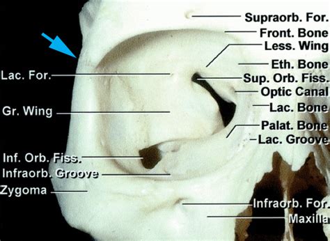 Orbitozygomatic Craniotomy The Neurosurgical Atlas