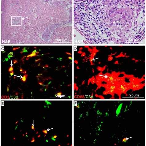 Hande Staining Of Ll Leprosy Skin Magnification 100 μm A And Zoom In