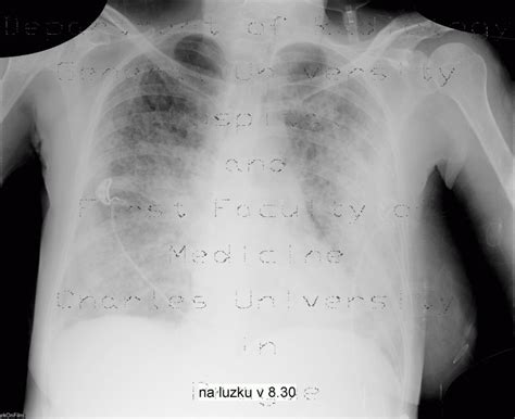 Radiology Case Atypical Pneumonia