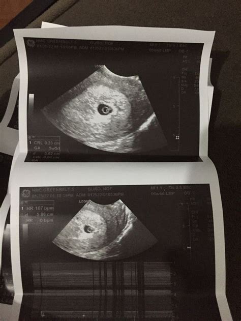 Pin by Aldii Feliciano on Guardado rápido in 2024 First ultrasound