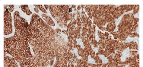 Immunohistochemical Analysis Showed Positive Cytokeratin AE1 AE3 A