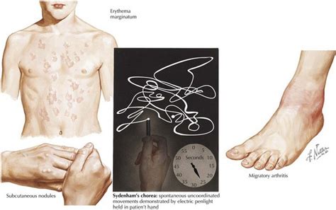 Subcutaneous Nodules Rheumatic Fever