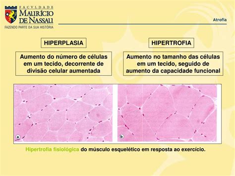 Hiperplasia E Hipertrofia - Diferenças Entre Hipertrofia E Hiperplasia - RETOEDU