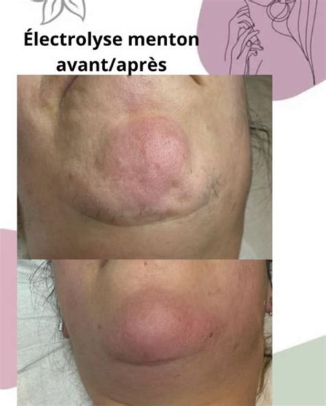 Epilation D Finitive Visage Pour Hommes Et Femmes Lyon Infos Et