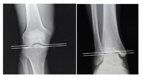 Intra And Extra Articular Deformity Of Lower Limb Tibial Condylar