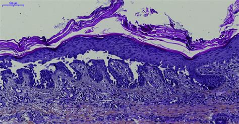 Skin Biopsy On Trunk Hematoxylin Eosin Staining Shows Hyperkeratosis