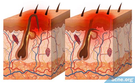 Diagram Of Ingrown Hair