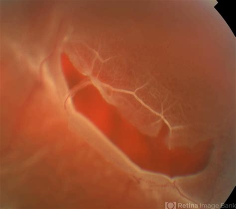 Retinal Tear At The Posterior Edge Of Lattice Degeneration Retina