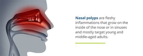 Symptoms, Causes & Treatment for Nasal Polyps In Houston