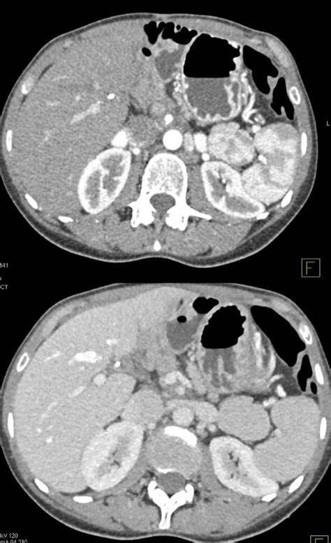 Gastrointestinal Learning Modules Ct Scanning