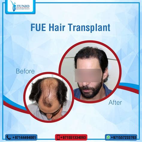 Best Hair Transplant In Dubai Tunio Aesthetics Artofit