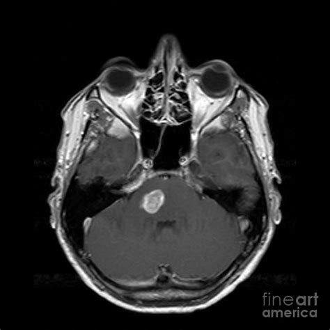 Brain Tumour By Simon Fraser Science Photo Library