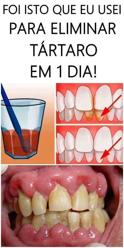 Em 2 Minutos Remova O Acúmulo De Placa Bacteriana E Tártaro Nos Dentes