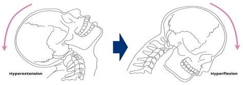 Whiplash Injury — Physio Solutions Merrylands