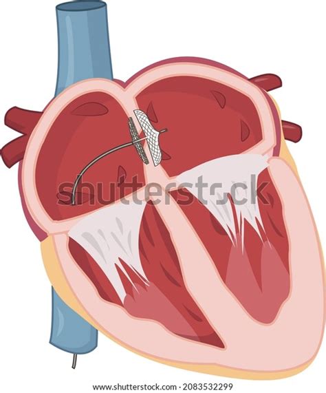 Pfo Closure Device Sealing Patent Foramen Stock Vector Royalty Free