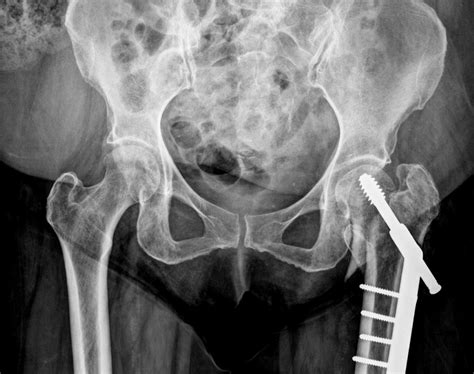 Femoral Intertrochanteric Fracture