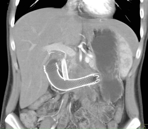 Pancreatic Cancer Invades The Duodenum Stents Placed In The Duodenum