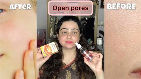 How To Minimize Open Pores This Remedy Treat Your Open Pores