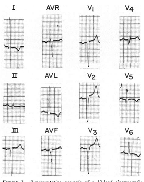 Figure From The Clinical Significance Of Exerciseinduced Stsegment