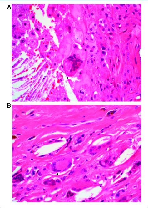 A Hande Staining Of The Inflammatory Infiltrate Composed Of Foreign Download Scientific